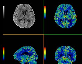 Ct Perfusion 4d Neuro Ge Healthcare Australia New Zealand Ct Perfusion 4d Neuro Ge Healthcare Australia New Zealand