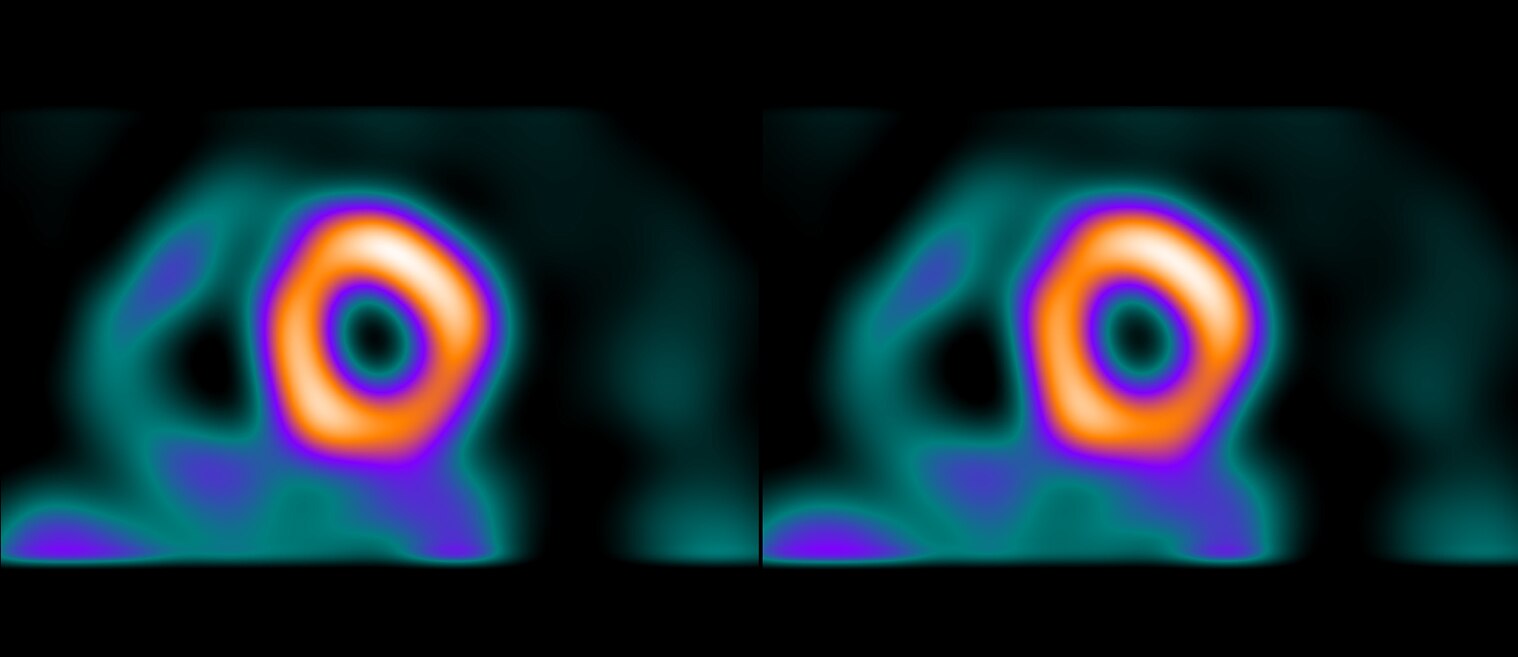 MYOCARDIAL BLOOD FLOW