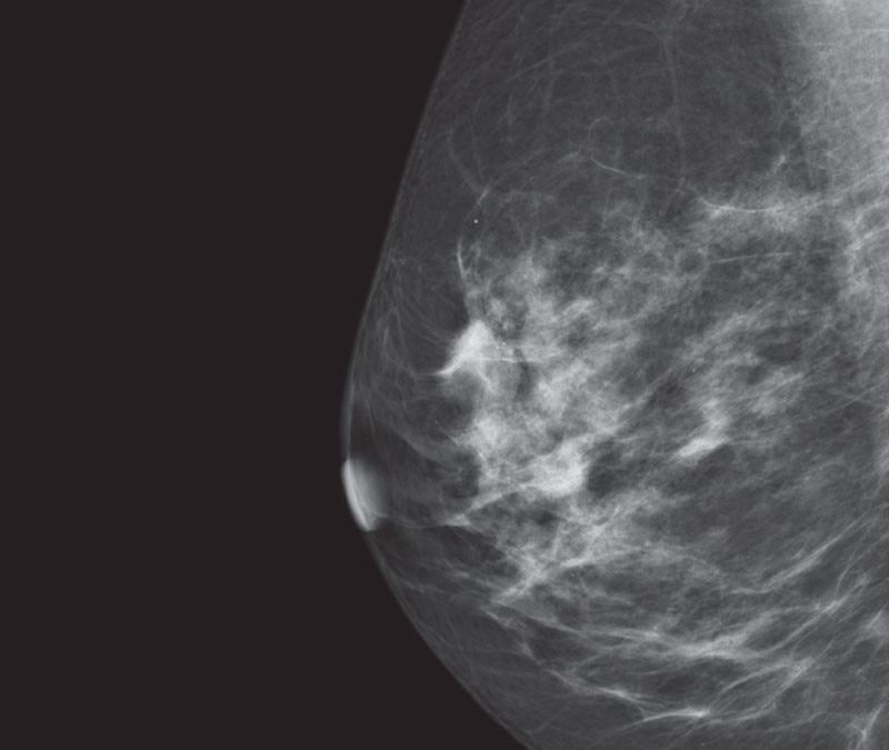 hy-mammography-new-seno-claire-thumbnails-senoclaire_breast-imaging-clarity-thumbnail1.jpg
